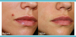 Dermatologist Skin Tag Removal – Safe & Effective Treatment at London Dermatology Clinic
