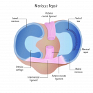 Ease Knee Pain with Reliable Meniscal Repair