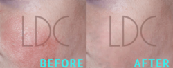 Rash Treatment London