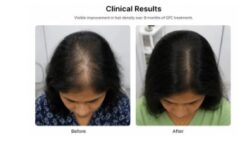 Safe GFC Hair Regrowth Treatment Mumbai doctor-led care