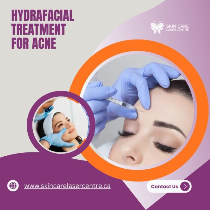 hydrafacial treatment for acne-1783404545l4c8p