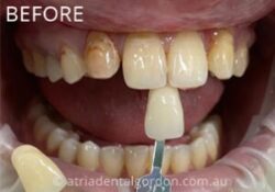 Dentist Killara – Trusted Dental Care for Healthy Smiles