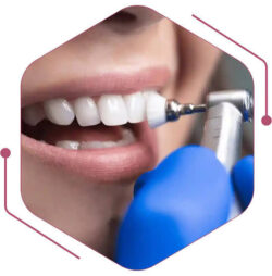 What Happens During Teeth Scaling?