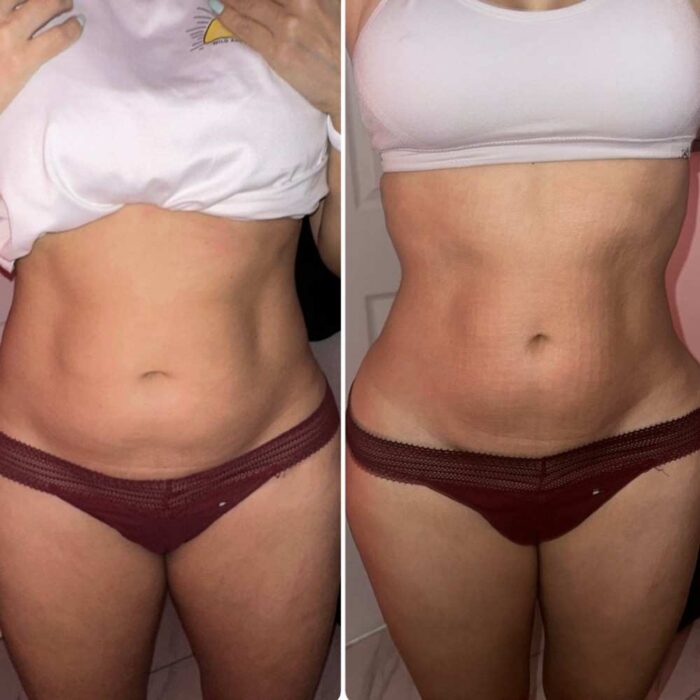 SnatchedLV Offers Body Sculpting in Summerlin for Body Contours