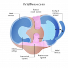 Understanding Partial Meniscectomy for Meniscus Tears
