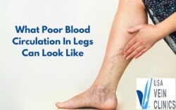 Poor Blood Circulation In Legs
